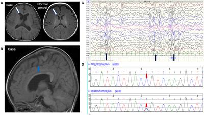 A Novel CNTNAP2 Mutation Results in Abnormal Neuronal E/I Balance